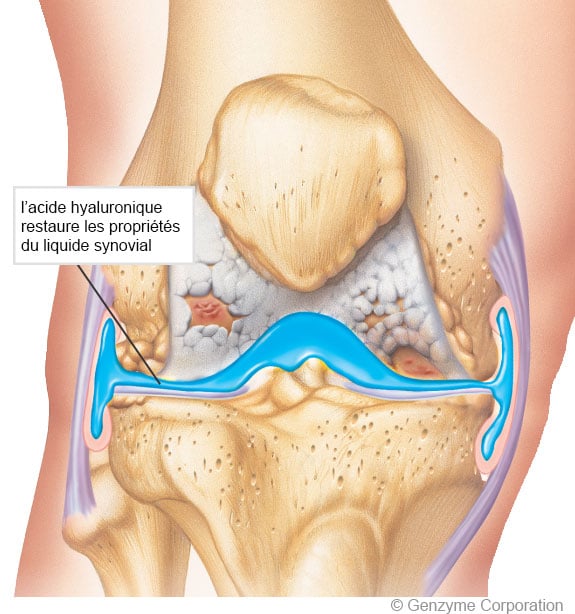 Arthrose du genou (gonarthrose) : les symptômes et traitements