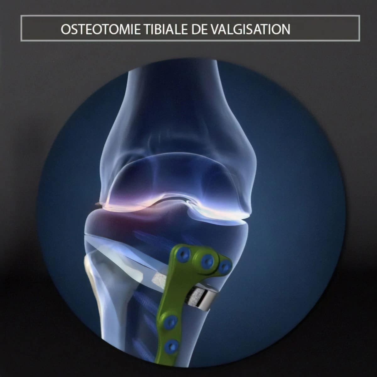 Ost Otomie Tibiale De Valgisation Sur Mesure Dr Philippe Loriaut