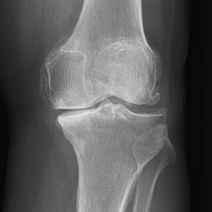 Arthrose du genou : Nouveau traitement - Centre de la douleur