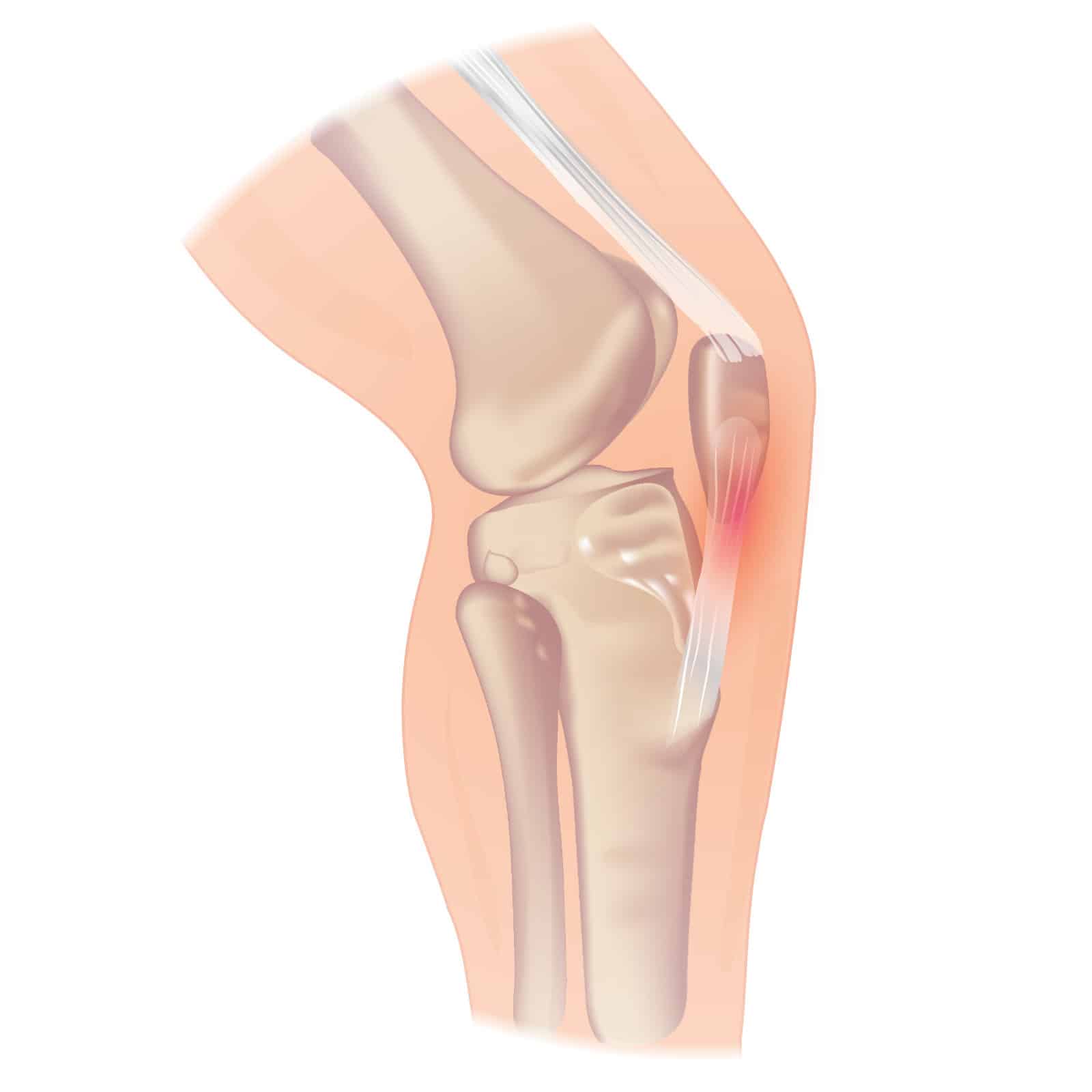 rupture du tendon patellaire